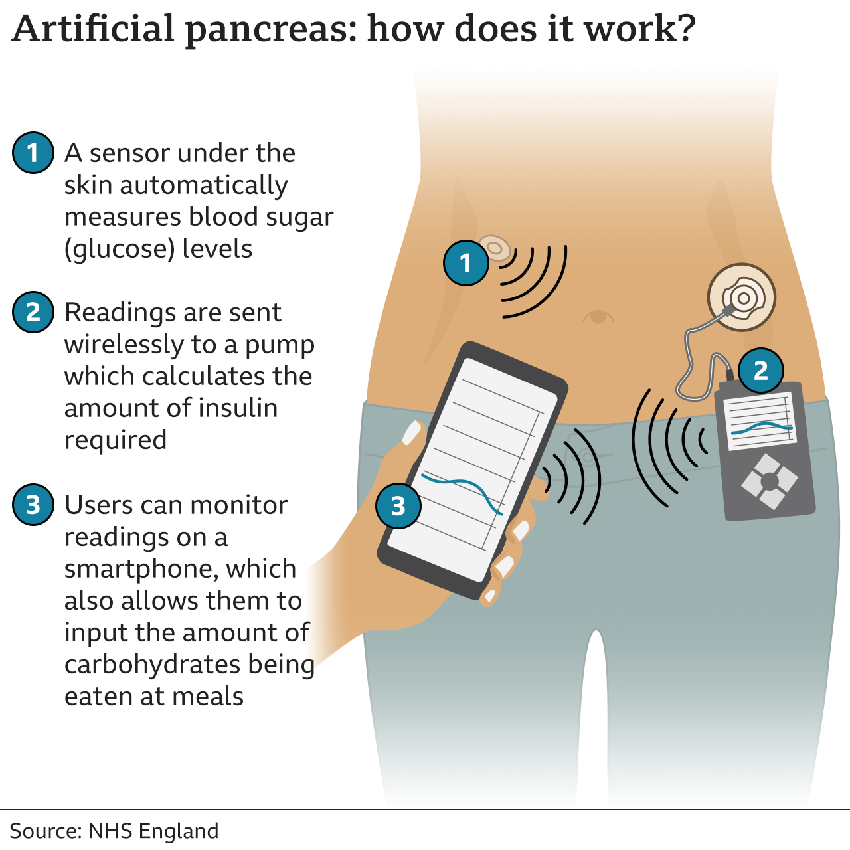 Artificial Pancreas to Revolutionise Diabetes Care